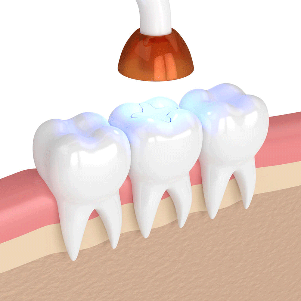 Fillings and Sealants